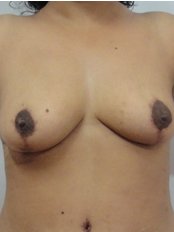 Breast Reduction - Ambrosia Clinic