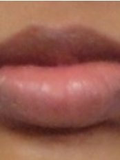 Lip Reduction - Ambrosia Clinic