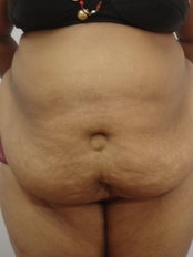Tummy Tuck - Ambrosia Clinic