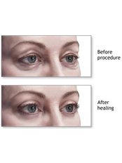 Eyelid Surgery - Cosmetic Center Hyderabad