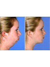 Chin Implant - Cosmetic Center Hyderabad