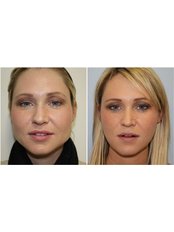 Buccal Fat Removal - Cosmetic Center Hyderabad