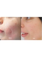 Scar Removal - Cosmetic Center Hyderabad