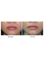 Lip Reduction - Cosmetic Center Hyderabad