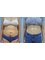 Dr. R. K. Mishra- Plastic & Cosmetic Surgeon -SIPS - A full Tummy-tuck (Before & After) 