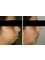 Dr. R. K. Mishra- Plastic & Cosmetic Surgeon -SIPS - Chin Augmentation (Sliding Genioplasty) before & After 