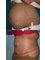 Dr Sumit Malhotra - SIPS Hospital - Tummy Tuck gives flatter abdomen 