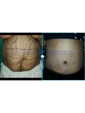 Full Abdominoplasty  - Dr Sumit Malhotra - SIPS Hospital