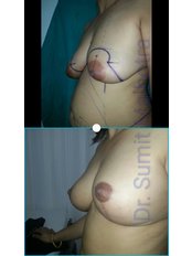 Breast Lift - Dr Sumit Malhotra - SIPS Hospital