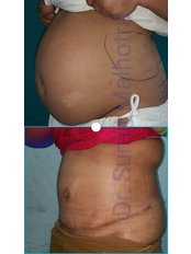 Full Abdominoplasty  - Dr Sumit Malhotra - SIPS Hospital