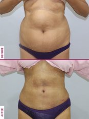 Liposuction - Allure Medspa - Andheri