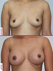 Breast Implants - Allure Medspa - Andheri