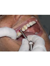 Immediate Implant Placement - Bombay Cosmetic Clinic