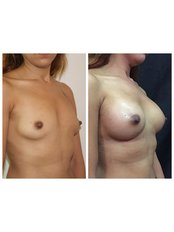 Breast Implant - Redefine Cosmetic Surgery Studio
