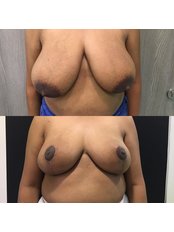 Breast Lift - Redefine Cosmetic Surgery Studio