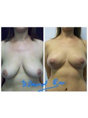 Breast Reduction - Redefine Cosmetic Surgery Studio