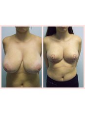 Breast reduction - Redefine Cosmetic Surgery Studio