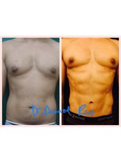 Abdominal Etching - Redefine Cosmetic Surgery Studio