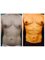 Redefine Cosmetic Surgery Studio - Liposuction Six Pack ABS 02 