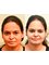 Rhinoplasty Clinic Bhatia Hospital - nasal tip plasty  