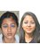 Rhinoplasty Clinic Bhatia Hospital - Broad Nose  