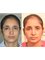 Rhinoplasty Clinic Bhatia Hospital - Crocked nose correction  