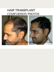 Dr Bakshi Cosmetic Clinic - hair transplant-laterall view