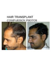 Dr Bakshi Cosmetic Clinic - hair transplant-laterall view 