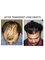 Dr Bakshi Cosmetic Clinic - hair transplant comparison pics of 24 years old male  