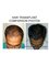 Dr Bakshi Cosmetic Clinic - hair transplant comparison.3000 hair grafts approx. 