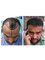 Dr Bakshi Cosmetic Clinic - hair transplant results after 6 months ... 3000 hair grafts transplanted 