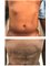 Hande Hospital - Liposuction abdome - Before and after 