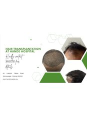 Hair Transplant - Hande Hospital