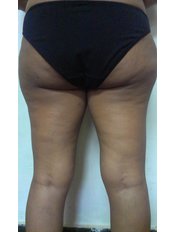 Thigh Reduction - Silkee Cosmetology Laser Centre