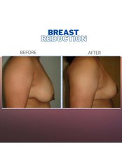 Breast Reduction - DR PRINCE PLASTIC & COSMETIC CLINIC