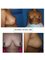 DR PRINCE PLASTIC & COSMETIC CLINIC - breast reduction surgery 