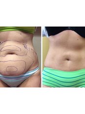 Liposuction - Baday Clinic