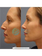Rhinoplasty Before and After - Baday Clinic