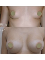Breast Implants - LMC Beauty Clinic