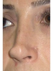 Nasal Tip Surgery - M&M Cosmetic Facial Surgery