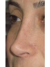 Nasal Tip Surgery - M&M Cosmetic Facial Surgery