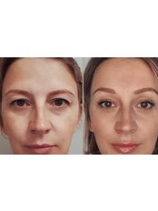 Endoscopic eyebrow lift and upper eyelid plastic surgery - Fi Clinica