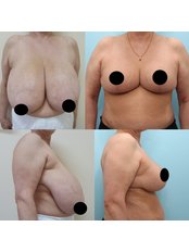 Breast Reduction - Grozio Chirurgija