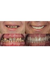 Dental Implants - Grozio Chirurgija