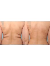 Liposuction - Grozio Chirurgija