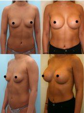 Breast Augmentation (including implants) - Grozio Chirurgija
