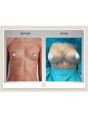 Breast Implants - Inmedica Beauty Clinic