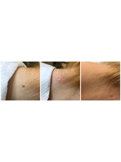 Mole Removal - Inmedica Beauty Clinic