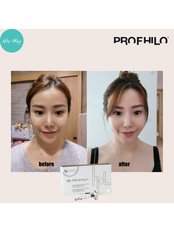 Profhilo® - Dr Wee Clinic (Mount Austin)