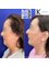 Kenneth Kok Plastic Surgery Clinic - Deep place facelift and necklift 
